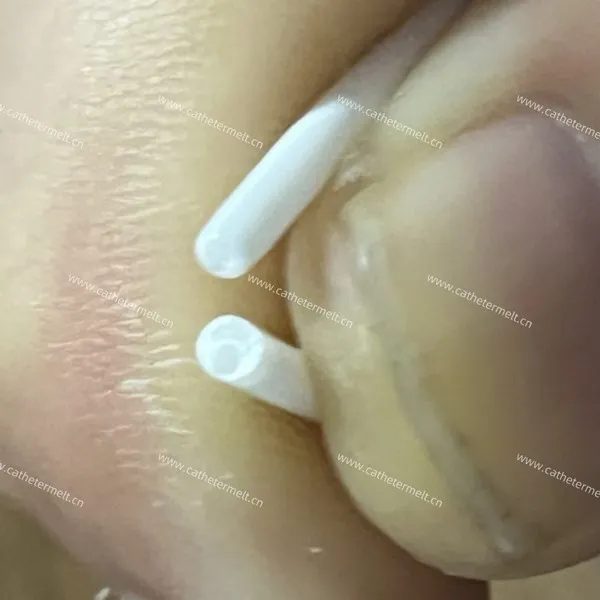 多腔管尖端成型